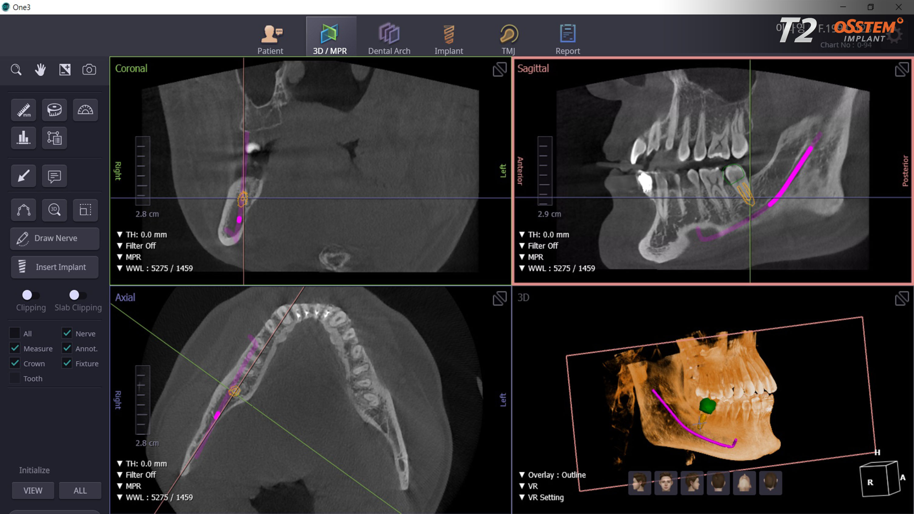 Close-up of 3D CBCT scan results showing jawbone detail for precise implant placement