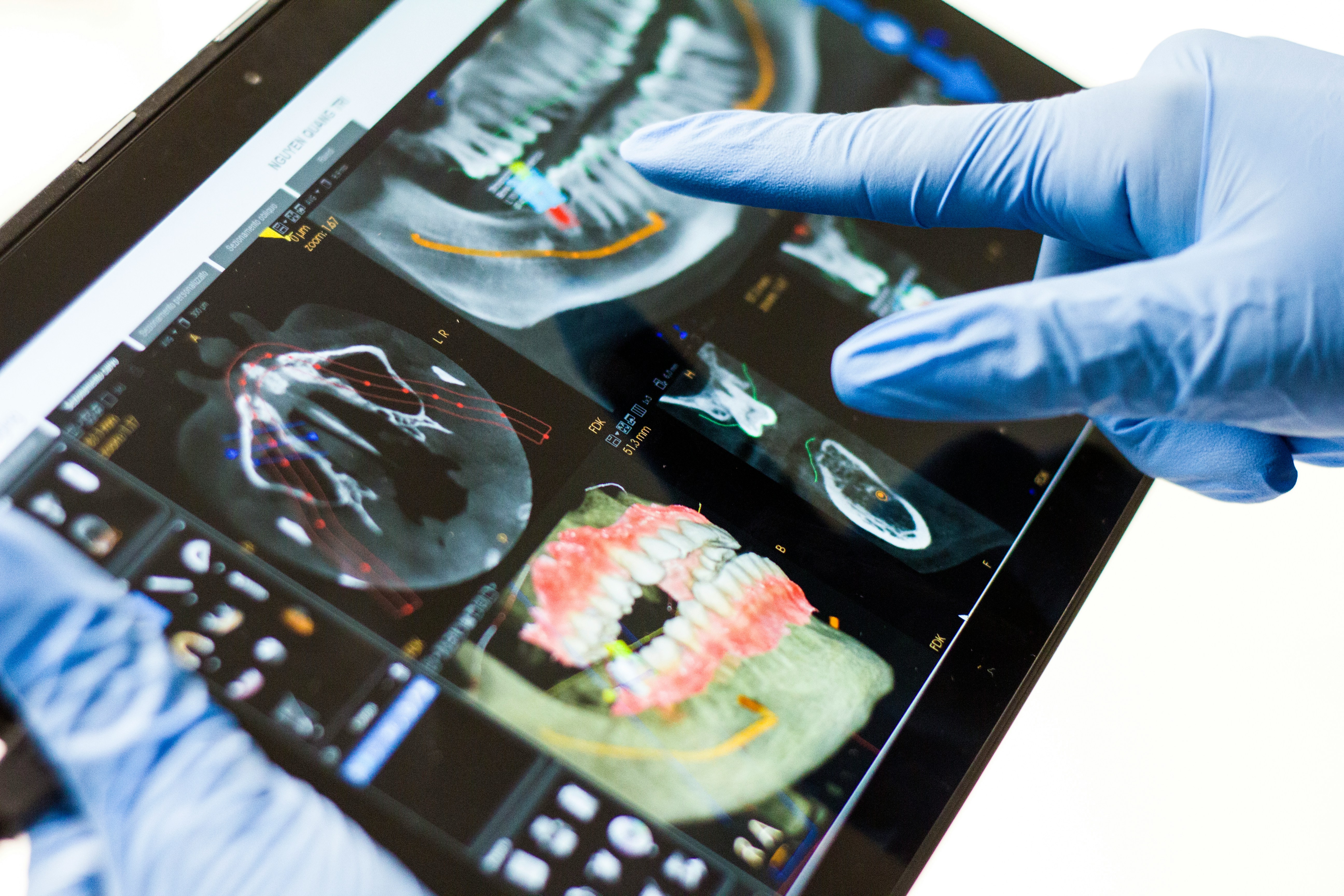 Dentist reviewing 3D CBCT scan on tablet for dental implant planning